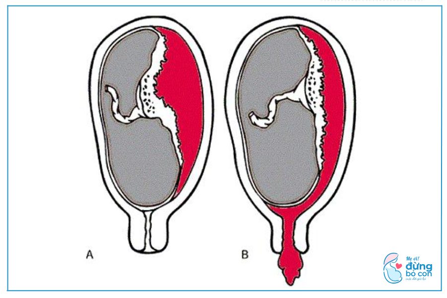 Tác Hại Của Việc Phá Thai 5 Tuần Chị Em Nên Biết